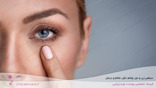 سیاهی زیر و دور چشم: علل، علائم و درمان