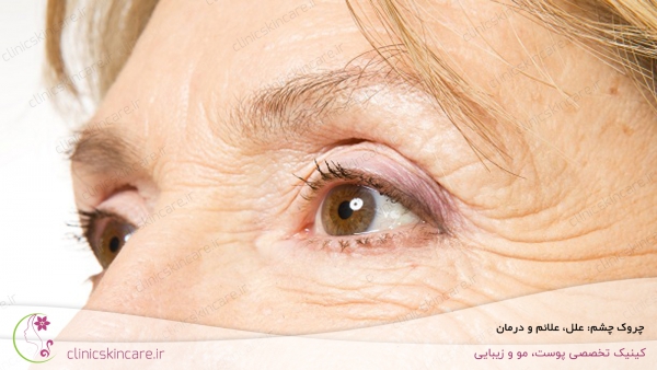 چروک چشم: علل، علائم و درمان